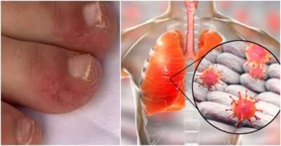 Cập nhật tối 3/5: “Ngón chân Covid-19” và 4 triệu chứng phát ban lạ; Virus corona có thể ‘trốn’ sâu trong phổi người đã khỏi bệnh