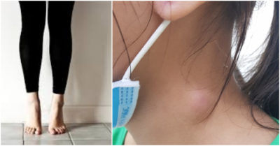 Tin Sức khỏe ngày 23/5: Hóc xương cá, 5 tháng sau ra cục u vùng cổ; Giảm nhiều bệnh nếu ‘nhón gót chân’ mỗi ngày