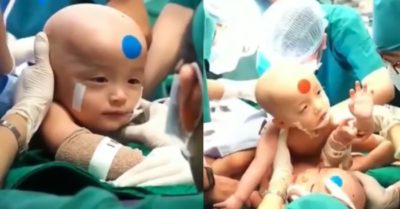 Ca tách dính song sinh: Bé Diệu Nhi đã cai máy thở; Trúc Nhi phản xạ tốt khi nghe giọng bố mẹ