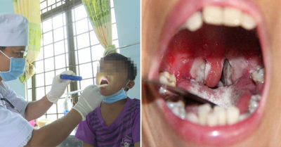 Đắk Lắk: Thêm 3 ca mắc bệnh bạch hầu