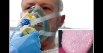 Bác sĩ cho biết triệu chứng mới của Covid-19: Lưỡi xuất hiện nốt sưng đỏ, trắng