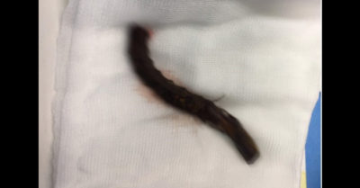 Hy hữu: Bị thanh sắt đâm xuyên sọ khi dắt xe đạp, người đàn ông được cứu kịp thời