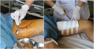 Bình rượu ổi nổ khi mở, nam thanh niên bị đứt cơ đùi