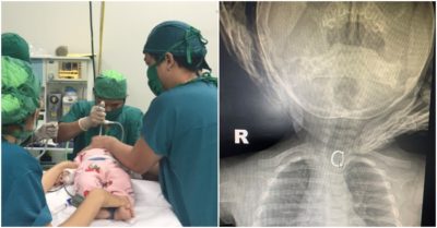 Bé gái 6 tháng tuổi ở Ninh Thuận nuốt khuyên tai vào thực quản