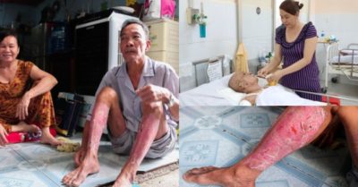 Cha già 2 lần lóc da cứu con: ‘Chọn lại hàng nghìn lần, tôi vẫn làm như vậy’