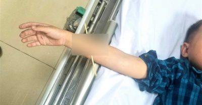 Que xiên thịt đâm xuyên cánh tay bé trai 6 tuổi