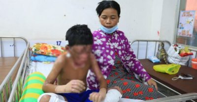 Cậu bé 9 tuổi dũng cảm vào cứu mẹ nuôi, bị bỏng nặng 64%