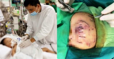 Bé trai 2 tuổi bị chó nhà cắn rách mặt