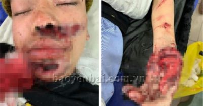 Điện thoại phát nổ khi vừa sạc vừa dùng, thiếu niên 15 tuổi bị dập bàn tay