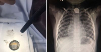 Bé trai 4 tuổi bị bỏng thực quản do nuốt viên pin