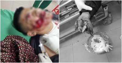 Nghịch pháo, 2 chú cháu bị nổ dập nát bàn tay