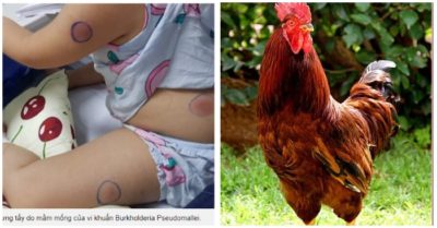 Bé 6 tuổi bị gà mổ vào chân, nhiễm vi khuẩn ăn thịt người