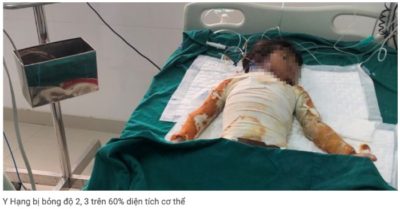 Bé gái bị phỏng nặng sau khi đốt rác vào mùng 1 Tết, gia đình không đủ tiền chữa trị