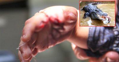 Bé trai 34 tháng tuổi ở Bạc Liêu bị cá sấu tấn công