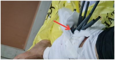 Va chạm với xe ba gác, nam thanh niên bị 11 thanh sắt phi 10 đâm xuyên chân