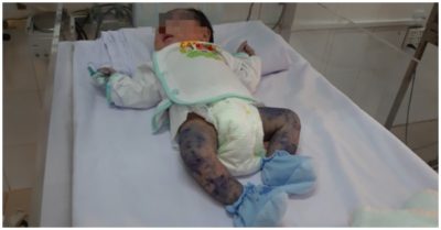 Bé trai bị thủy đậu hiếm gặp khi mới chào đời được 13 ngày