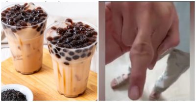Video uống quá nhiều trà sữa và ăn không khoa học, cậu bé 14 tuổi bị sưng phồng các khớp ngón tay