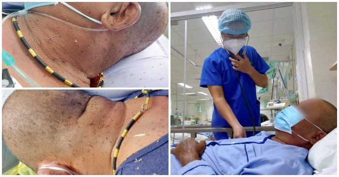 Bệnh nhân nhập viện với hàng trăm vết ong đốt (ảnh chụp màn hình trên báo Người Lao Động/Zing).