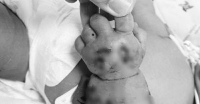 Bé sơ sinh nằm võng bị máy may đè dập nát cánh tay