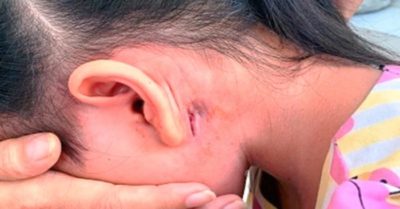 Phát hiện một bệnh nhi mắc ‘vi khuẩn ăn thịt người’